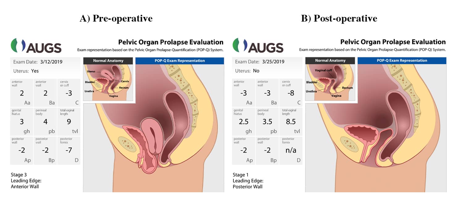 Figure 1. Graphic Demonstration of Pre- and Postoperative POP-Q Measurements