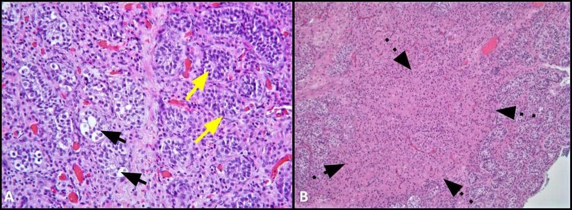 et al.et al.et al.et al.et al.et al.et al.et al.et al.et al.Germ cell neoplasia in situ (GCNIS). Large atypical cells (black 