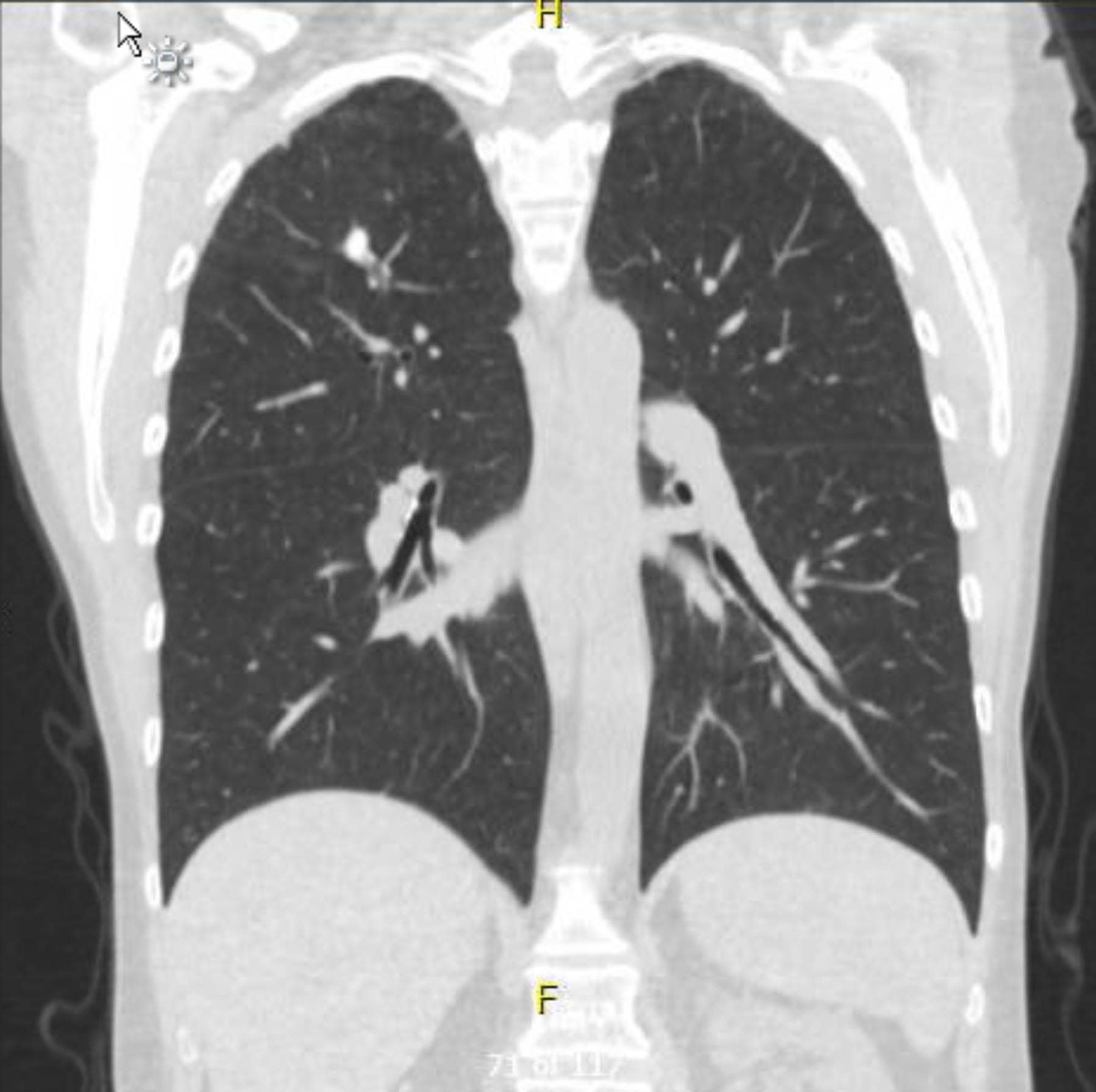 171_Figure1_CoronalCT