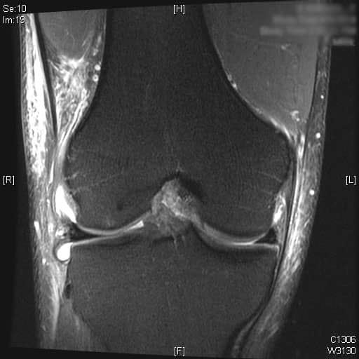 ACL MRI COronal 1