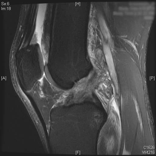 ACL MRI Notch 1