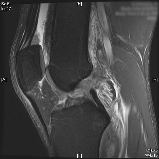 ACL MRI Notch 2