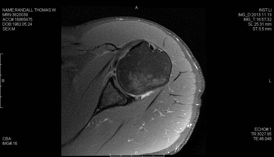 Axial T1 Weighted