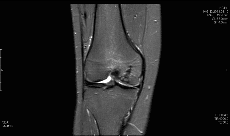 STIR Magnetic resonance imaging demonstrating osteochondral defect