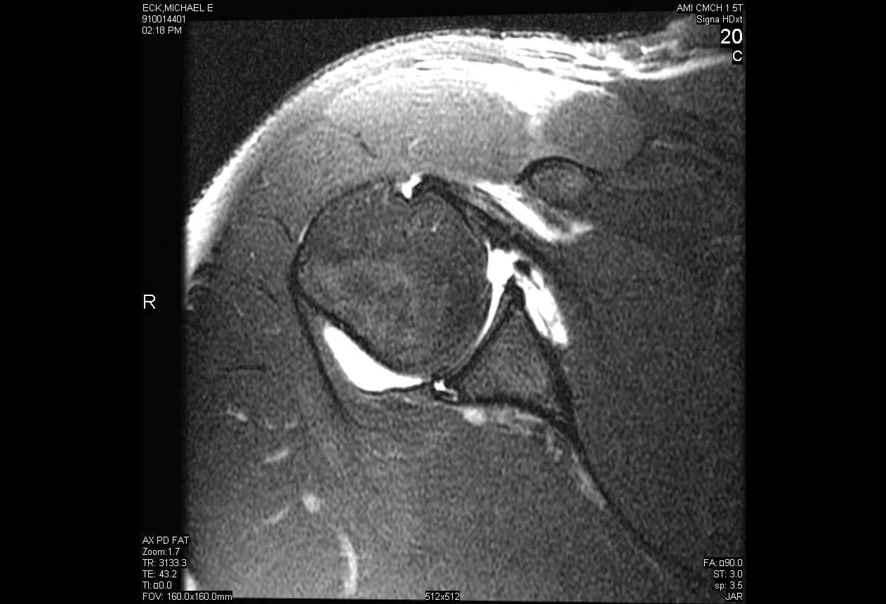 Axial Proton-density fat saturation