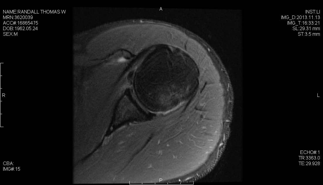 Axial Proton-density fat saturation