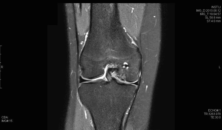 Coronal T2 Magnetic resonance imaging demonstrating osteochondral defect