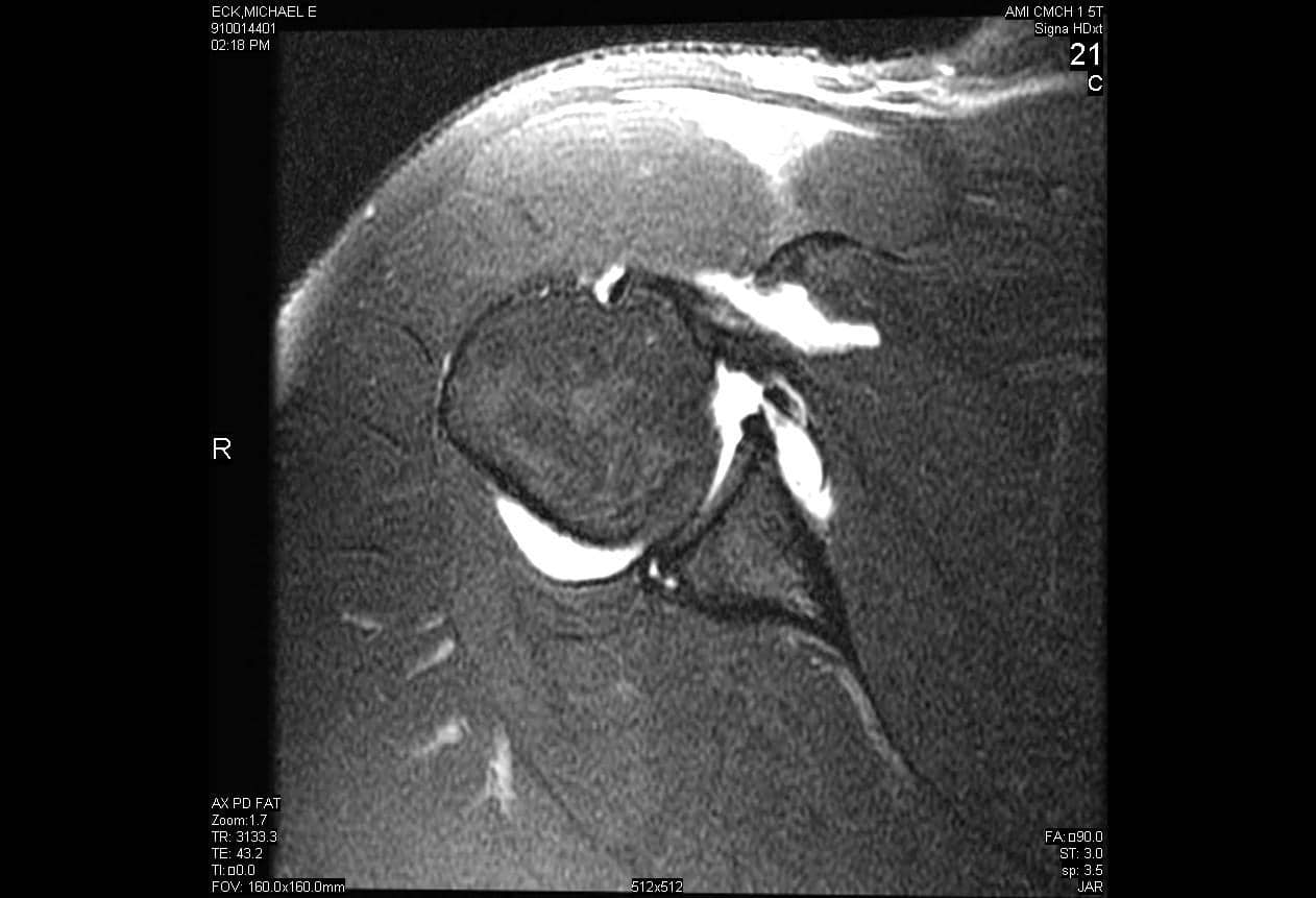 Coronal Proton-density fat saturation