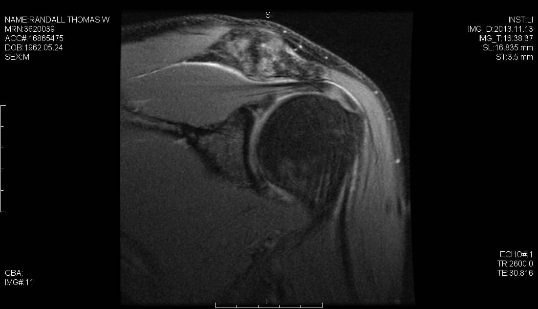 Coronal Proton-density fat saturation