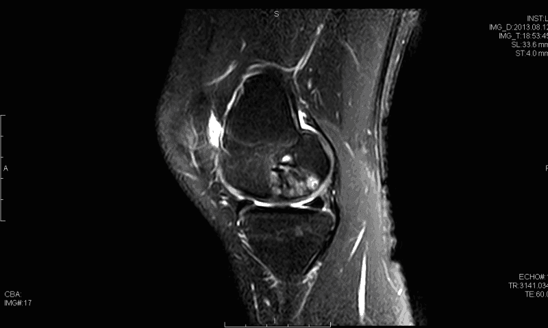 Sagittal T2 Magnetic resonance imaging demonstrating osteochondral defect