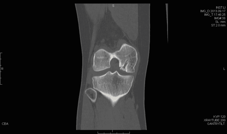 Coronal computed tomography imaging demonstrating bony aspect of the defect