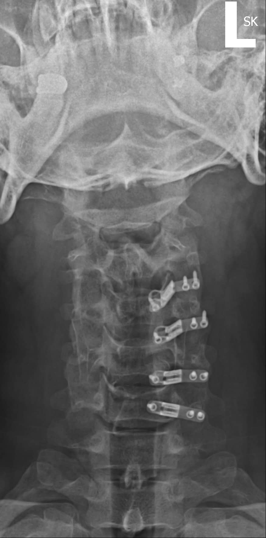 AP cervical spine