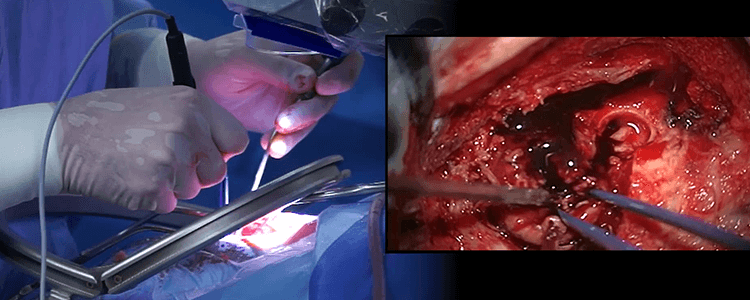 extraventricular-drainage-hematoma-evacuation