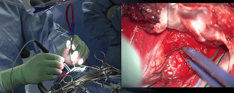 resection-sphenoid-wing-meningioma