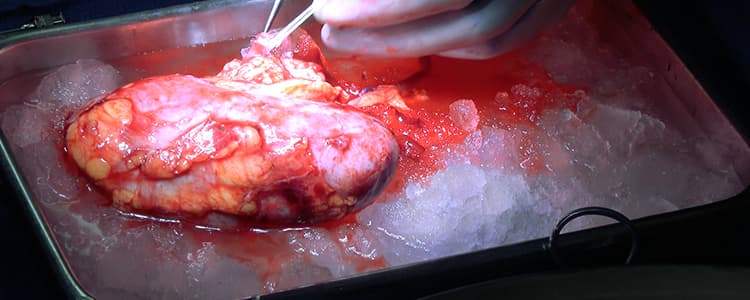 left-laparoscopic-donor-nephrectomy