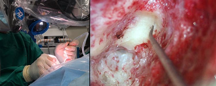 Transmastoid-Repair-of-Superior-Semicircular-Canal-Dehiscence