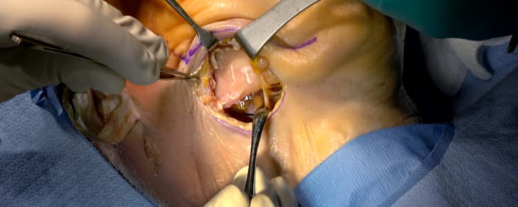 submandibular-approach-to-the-mandible-cadaver