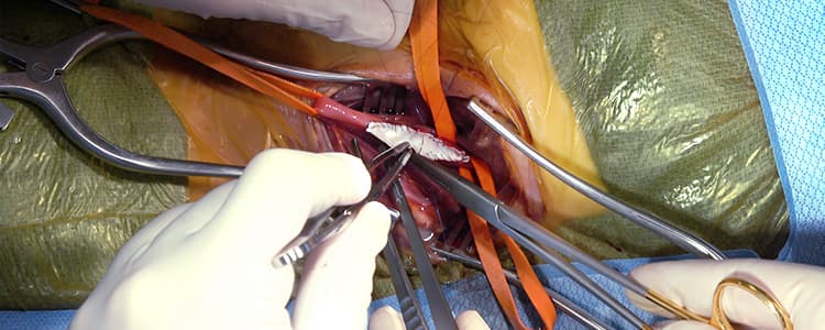 carotid-endarterectomy-cadaver