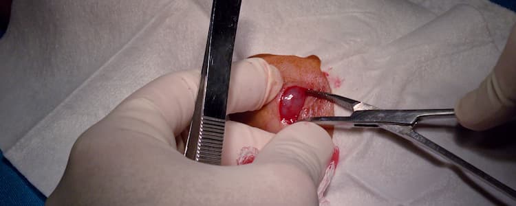 Pediatric-Excision-of-Ganglion-Cyst-from-Right-Wrist