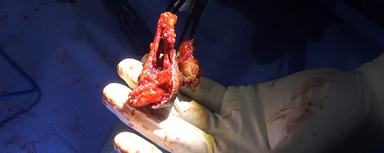 Fine-Needle-Aspiration-Biopsy-and-Excision-Biopsy-of-a-Cystic-Mass-in-the-Right-Breast-(Male)