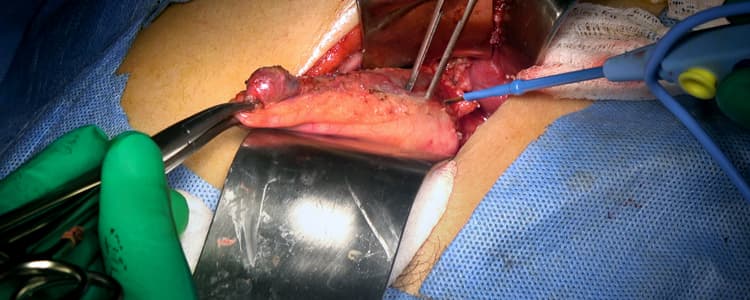 open-cholecystectomy-for-gallstone-disease