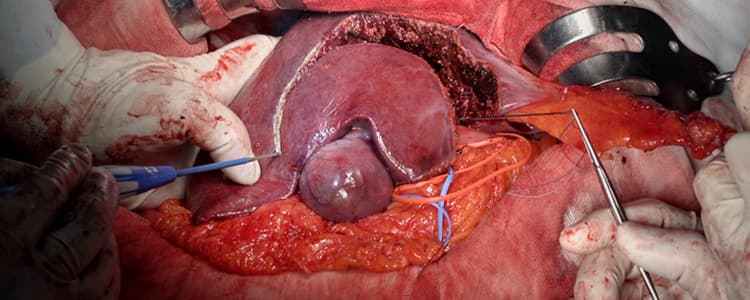 open-radical-cholecystectomy-with-partial-hepatectomy-for-gallbladder-cancer