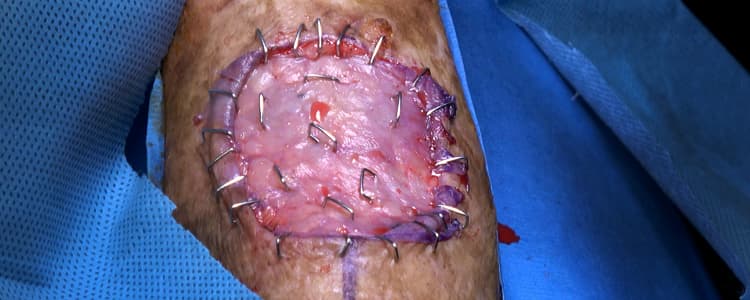 squamous-cell-carcinoma-excision-from-right-forearm-with-split-thickness-skin-graft-from-the-thigh