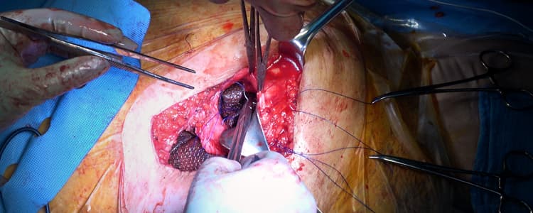 intraperitoneal-mesh-repair-for-incisional-hernia