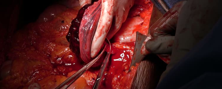 exploratory-laparotomy-and-splenectomy-for-ruptured-spleen-following-blunt-force-trauma