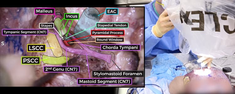 temporal-bone-dissection-(cadaver)