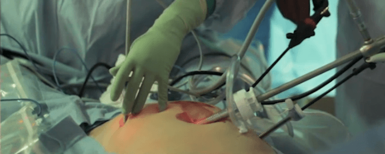 laparoscopic-sigmoid-resection-for-diverticulitis